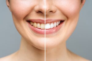 Transform your Smile with Teeth Whitening in Brooklyn, NY