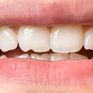 Chipped or broken tooth solutions by Beyond Dentistry Laser Center in Brooklyn, NY